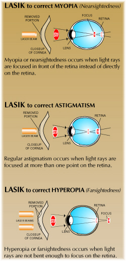 myopia astigmatism lasik)